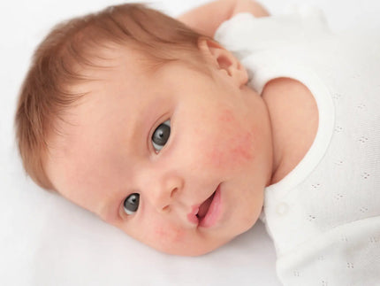 Baby acne: wat je moet weten en hoe je het kunt behandelen