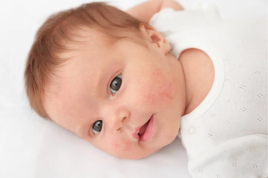 Baby acne